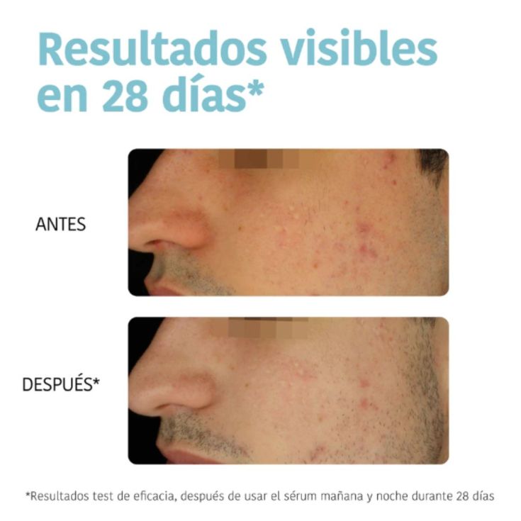 iroha nature serum facial antiimperfecciones 30ml